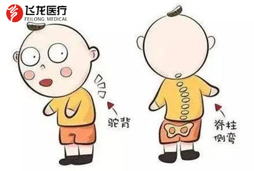 年輕人脊柱側(cè)彎 年輕人脊柱側(cè)彎