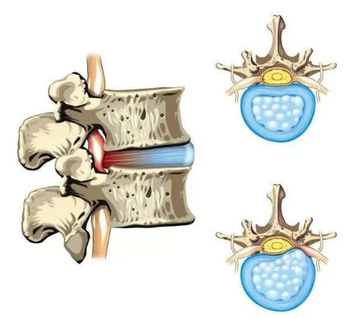 椎間盤(pán)解剖 椎間盤(pán)解剖
