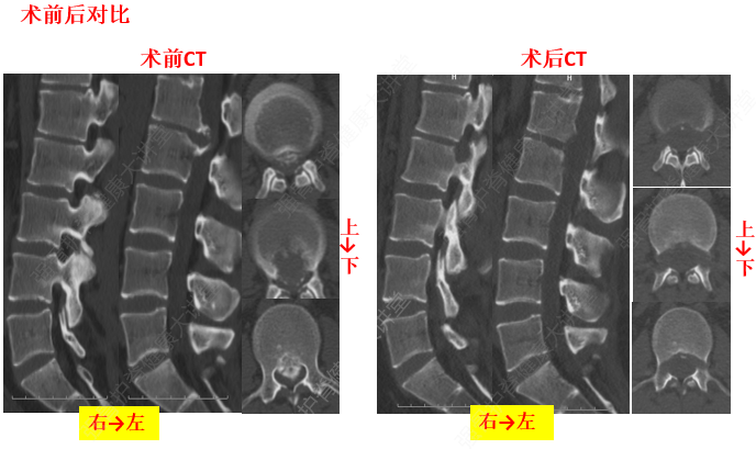 椎體緣骨贅形成 椎體緣骨贅形成