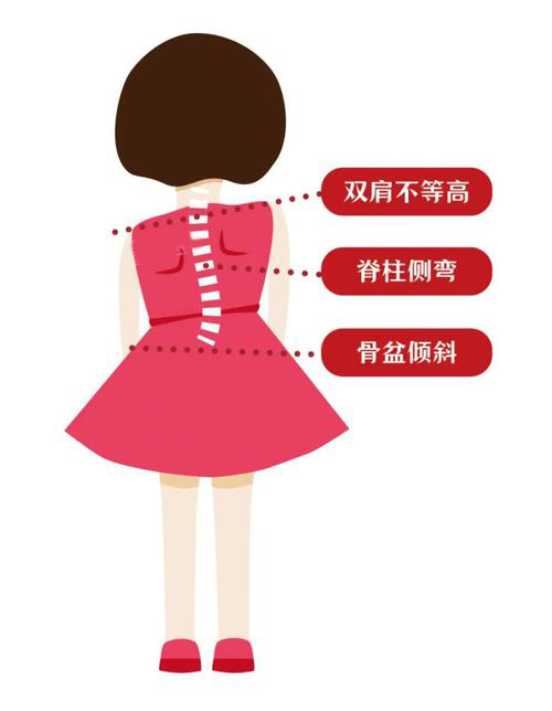 脊柱側彎彎曲異常 脊柱側彎彎曲異常